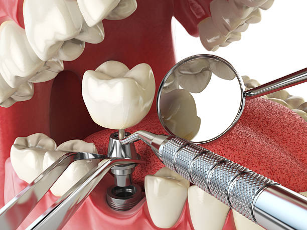 Best Lost Filling or Crown Replacement in Coalfield, TN